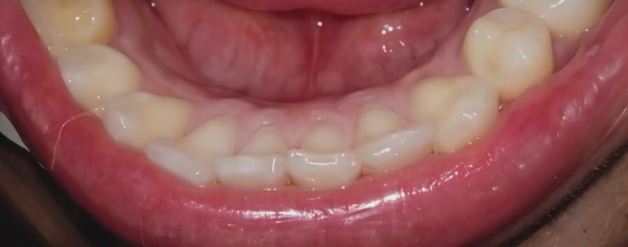 After Oral Prophylaxis