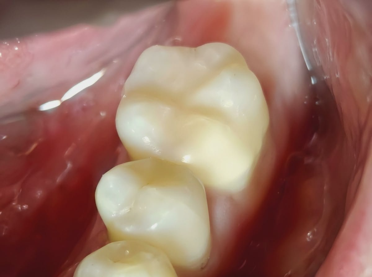 After Tooth Restoration