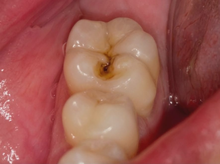 Before Tooth Restoration