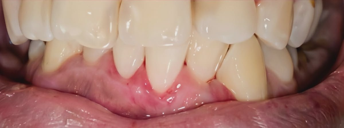 After Teeth Whitening