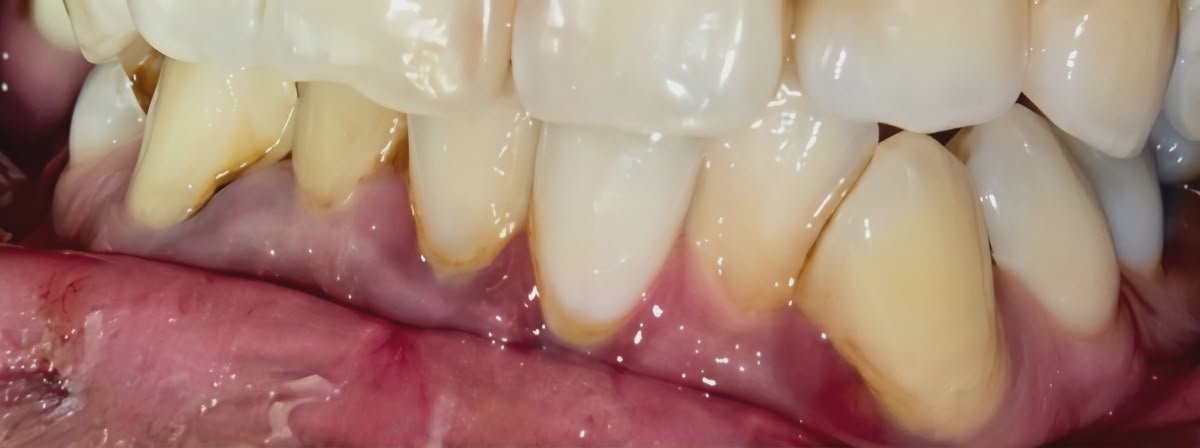 Before Teeth Whitening